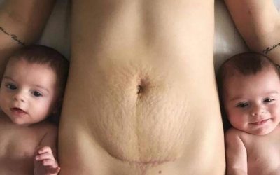 ‘Your scar DOES NOT define you’ Mum of twins shares empowering C-section scar photo that’s now gone viral