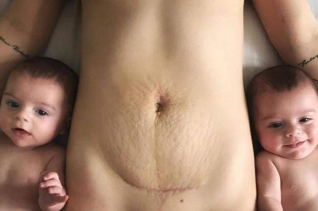 c-section-scar-emily-marson